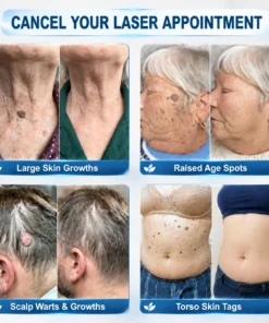 NEYEROS®✨ 𝟕-𝐃𝒂𝘆 𝐒𝗸𝐢𝐧 𝐓𝒂𝗴 & 𝐒𝐩𝙤𝐭 𝐄𝐫𝒂𝐬𝙚𝐫 𝐏𝐚𝐢𝐧𝐥𝐞𝐬𝐬 & 𝐒𝐜𝐚𝐫-𝐅𝐫𝐞𝐞 𝐀𝐝𝐯𝐚𝐧𝐜𝐞𝐝 𝐈𝐦𝐩𝐞𝐫𝐟𝐞𝐜𝐭𝐢𝐨𝐧 𝐑𝐞𝐦𝐨𝐯𝐚𝐥 𝐑𝐨𝐥𝐥𝐞𝐫𝐛𝐚𝐥𝐥 𝐏𝐞𝐧