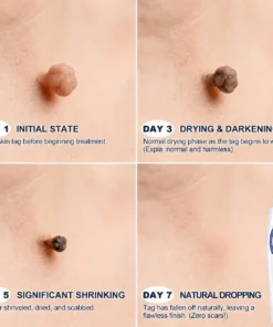 NEYEROS®✨ 𝟕-𝐃𝒂𝘆 𝐒𝗸𝐢𝐧 𝐓𝒂𝗴 & 𝐒𝐩𝙤𝐭 𝐄𝐫𝒂𝐬𝙚𝐫 𝐏𝐚𝐢𝐧𝐥𝐞𝐬𝐬 & 𝐒𝐜𝐚𝐫-𝐅𝐫𝐞𝐞 𝐀𝐝𝐯𝐚𝐧𝐜𝐞𝐝 𝐈𝐦𝐩𝐞𝐫𝐟𝐞𝐜𝐭𝐢𝐨𝐧 𝐑𝐞𝐦𝐨𝐯𝐚𝐥 𝐑𝐨𝐥𝐥𝐞𝐫𝐛𝐚𝐥𝐥 𝐏𝐞𝐧